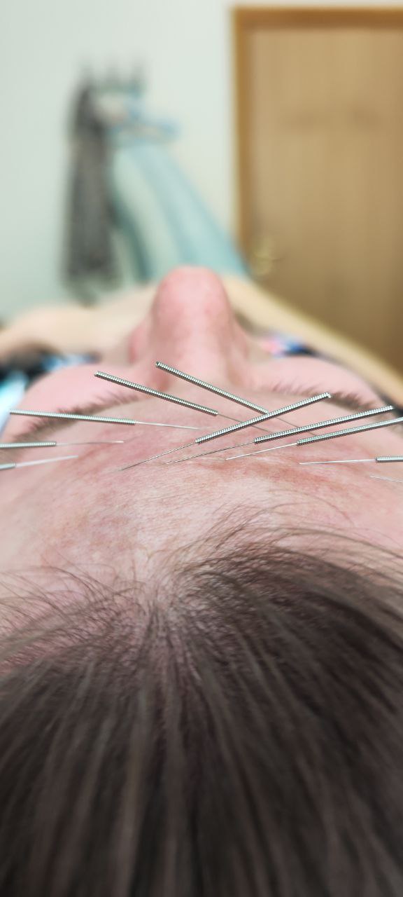 Иглоукалывание