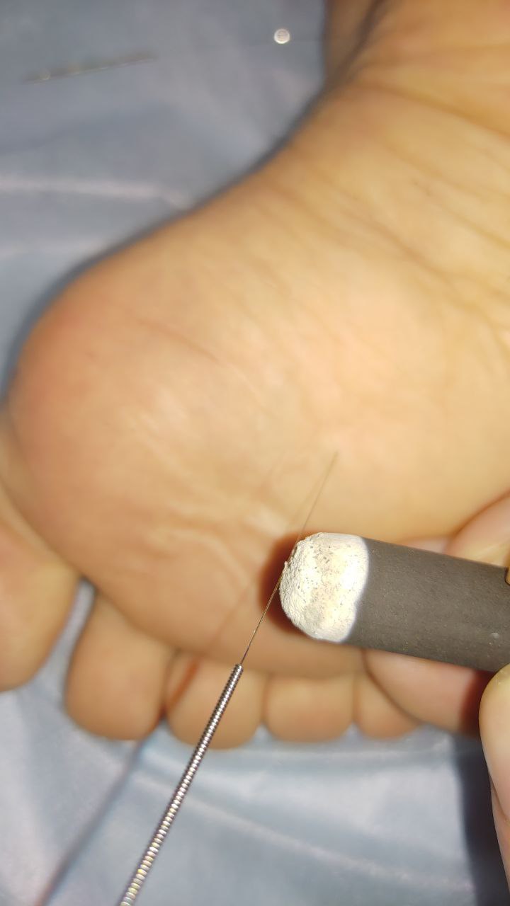 Иглотерапия