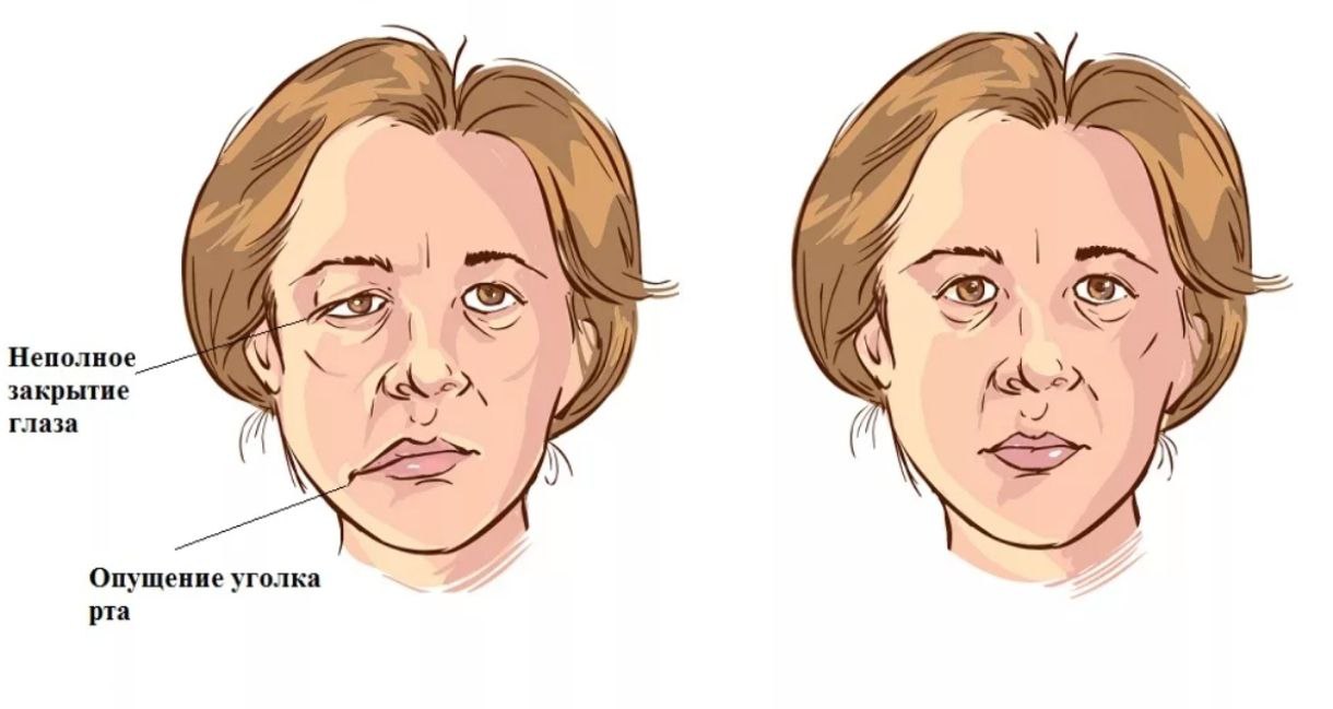 Реабилитация лицевого нерва